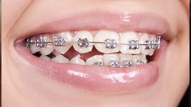 فوائد وأضرار تقويم الأسنان