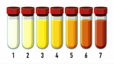 ما السبب تغيّر لون البول إلى الأخضر والأزرق؟