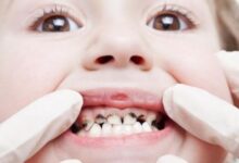 مخاطر ونصائح تسوس الأسنان اللبنية..