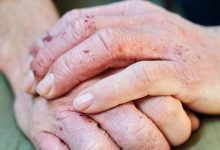 وصفة طبيعية لعلاج الإكزيما