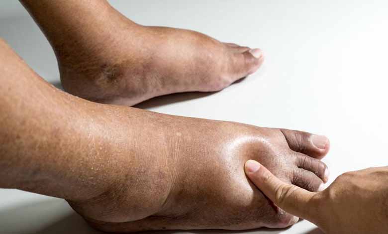 البتر وداء السكري- كيف تحمي قدميك