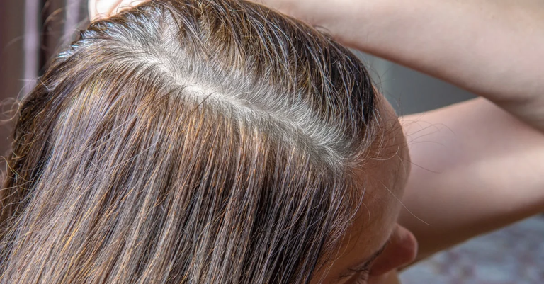 نقص الميلانين في الشعر.. 6 أسباب تؤدي إليه وطرق بسيطة للعلاج