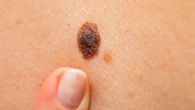 أعراض وطرق الوقاية من سرطان الجلد