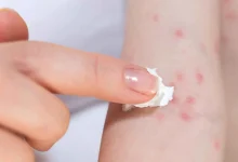 تعيش معك بصمت.. تعرف على أكثر 5 مهيجات للحساسية داخل البيت