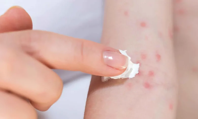 تعيش معك بصمت.. تعرف على أكثر 5 مهيجات للحساسية داخل البيت