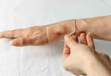 كيف تساهم شرائح السيليكون في تحسين مظهر الندوب؟
