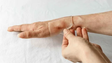كيف تساهم شرائح السيليكون في تحسين مظهر الندوب؟