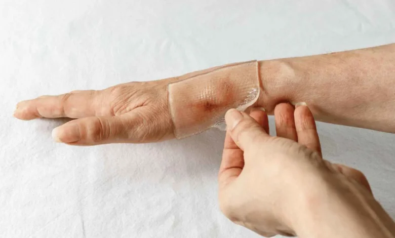 كيف تساهم شرائح السيليكون في تحسين مظهر الندوب؟