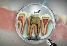 لصحة قلبك فكر بالأسنان أولا: علاج العصب يقلل خطر أمراض القلب