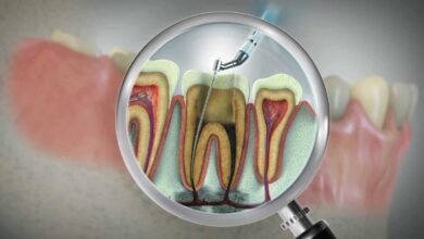 لصحة قلبك فكر بالأسنان أولا: علاج العصب يقلل خطر أمراض القلب