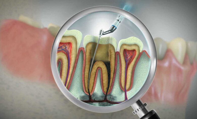 لصحة قلبك فكر بالأسنان أولا: علاج العصب يقلل خطر أمراض القلب
