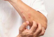 العلوم تشرح سر تعلق البعوض ببعضنا أكثر من الآخرين