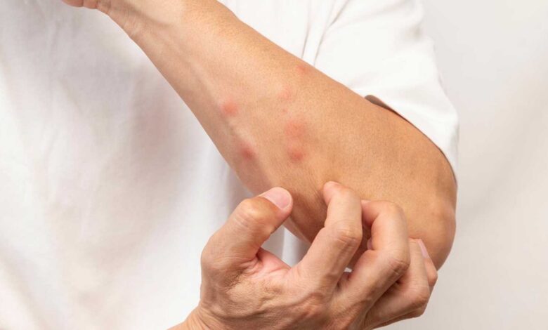 العلوم تشرح سر تعلق البعوض ببعضنا أكثر من الآخرين