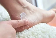 تقرحات القدم مع الحرارة.. كيف تعالج الكالوس بطرق آمنة؟