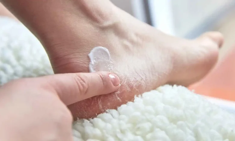 تقرحات القدم مع الحرارة.. كيف تعالج الكالوس بطرق آمنة؟