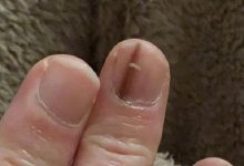 سرطان يختبئ تحت الأظافر.. إشارة صغيرة قد تنقذ حياتك