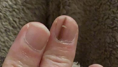 سرطان يختبئ تحت الأظافر.. إشارة صغيرة قد تنقذ حياتك