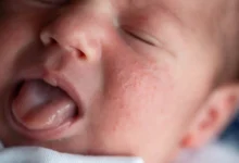 الطفح الحراري لدى الأطفال.. نصائح للوقاية خلال ارتفاع درجات الحرارة
