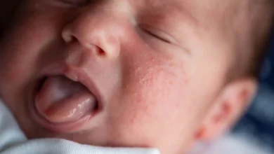 الطفح الحراري لدى الأطفال.. نصائح للوقاية خلال ارتفاع درجات الحرارة