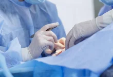 مضاعفات خطيرة لجراحة تجميلية تحرم امرأة من إغلاق جفنيها