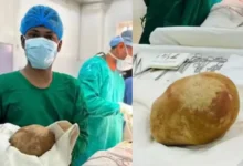 حصوة استثنائية في المثانة.. عملية جراحية تنهي معاناة رجل