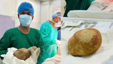 حصوة استثنائية في المثانة.. عملية جراحية تنهي معاناة رجل