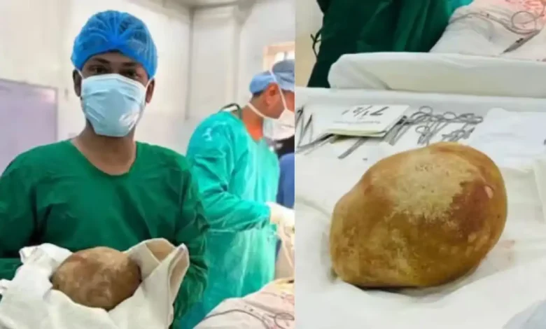 حصوة استثنائية في المثانة.. عملية جراحية تنهي معاناة رجل