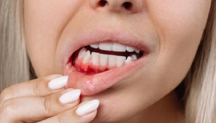 لا تتجاهل نزيف اللثة.. فقد يكون مؤشرًا على خطر صحي أكبر