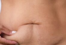 لماذا يترهل الجلد بعد خسارة الوزن؟ وكيف يمكن علاجه؟