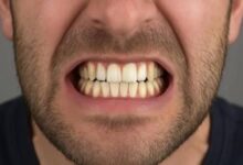 أسنانك تدفع ثمن التوتر.. لماذا يزداد صرير الأسنان بين الشباب؟