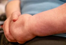 دهون مؤلمة في الساقين والذراعين.. تعرّف على الوذمة الشحمية