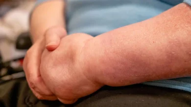 دهون مؤلمة في الساقين والذراعين.. تعرّف على الوذمة الشحمية